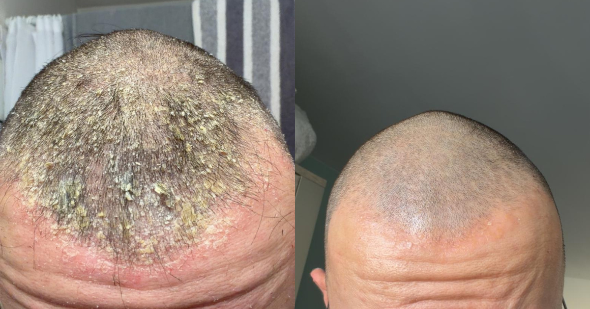 Huile de nigelle et psoriasis : ce que montrent les études Image